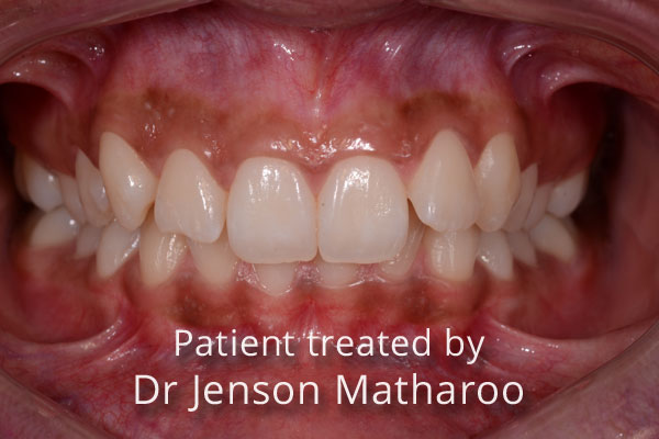 Before Fixed Metal Braces in Dumfries
