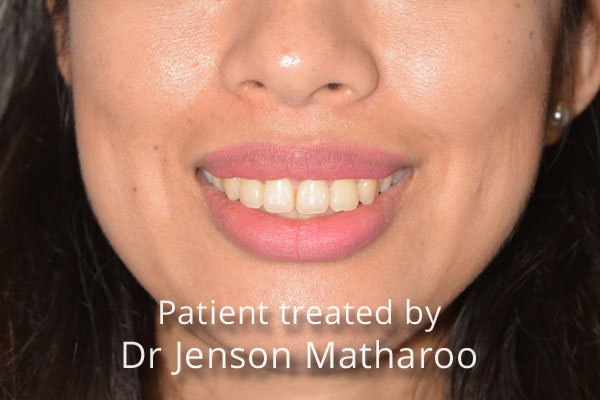 After Discreet White Braces in Dumfries
