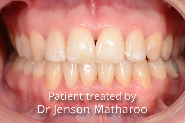 After Discreet White Braces in Dumfries