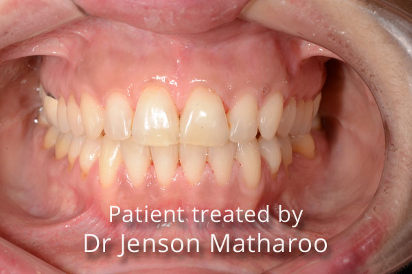 after Discreet White Braces in Dumfries