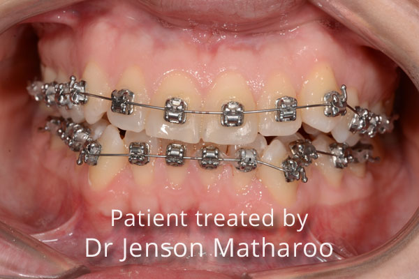 Before Fixed Metal Braces in Dumfries